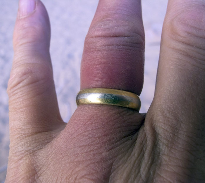 Jak zdjąć pierścionek ze spuchniętego palca?